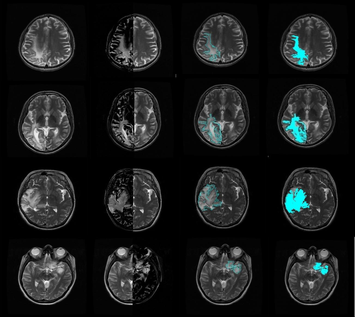 Segmented Tumor Example